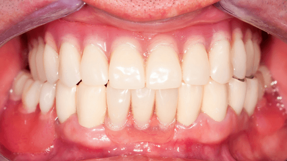 Full Mouth Rehab After Treatment