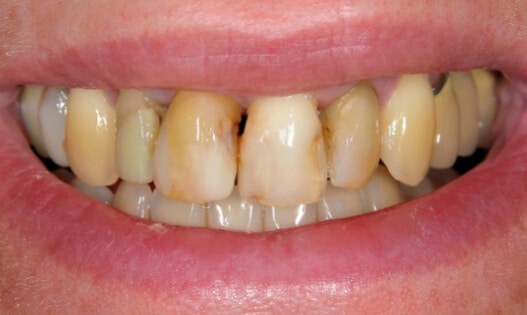 Teeth In a Day Before Treatment