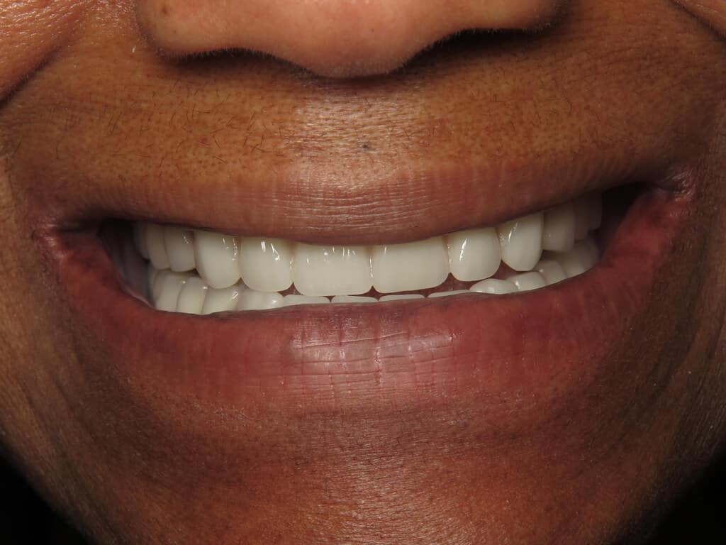 Restore Teeth Function Macon GA