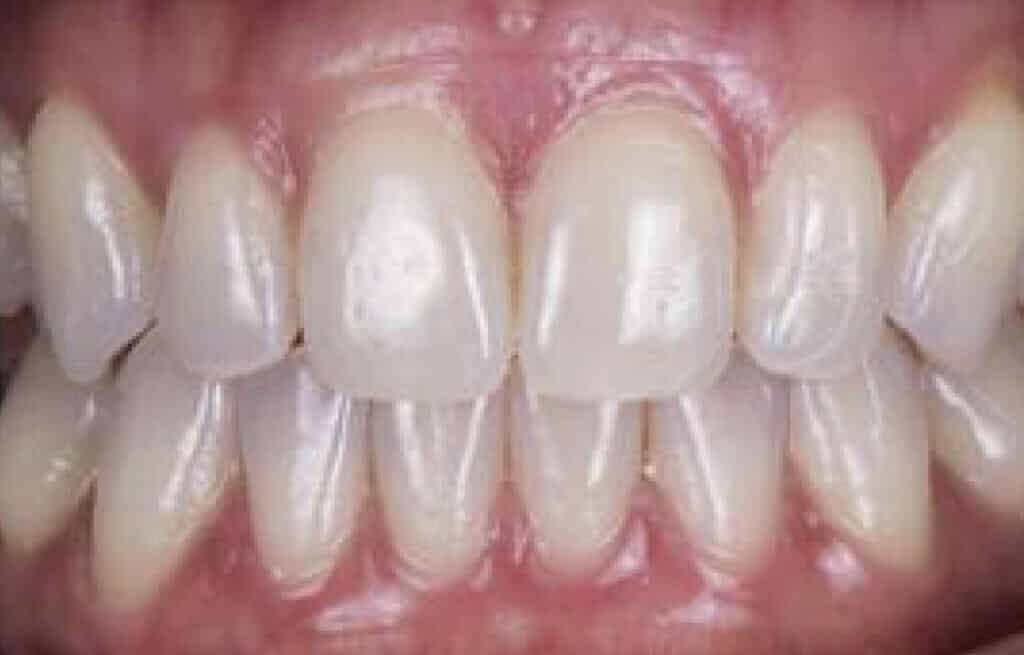 Tooth Repair Macon GA