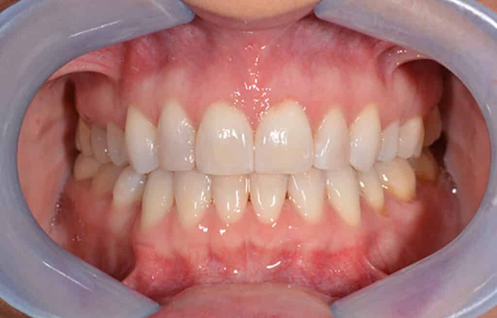 Prevent Teeth Shifting Macon GA